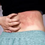 Disseminated Shingles: What It Is and When to Seek Help