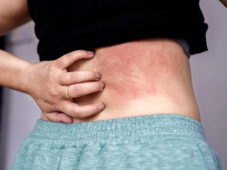 Disseminated Shingles: What It Is and When to Seek Help