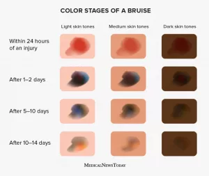 Age of Bruise Based on Color: The Story Hidden in Your Skin Age of Bruise Based on Color: The Story Hidden in Your Skin