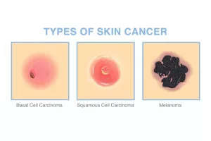 Basal Cell Carcinoma Stages Pictures Guide