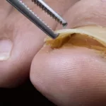 What If Big Toenail Fell Off Completely?