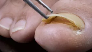 Big Toenail Fell Off Completely? Read This Before You Panic