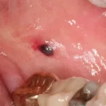 Black Spot Mouth Cancer: What That Little Mark Could Mean Black Spot Mouth Cancer: What That Little Mark Could Mean