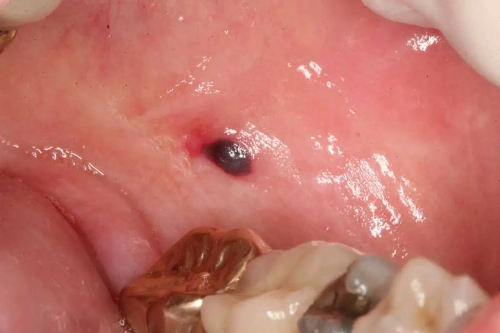 Black Spot Mouth Cancer: What That Little Mark Could Mean