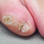 Blister on Bottom of Pinky Toe from Walking: The Journey No One Talks About Blister on Bottom of Pinky Toe from Walking: The Journey No One Talks About