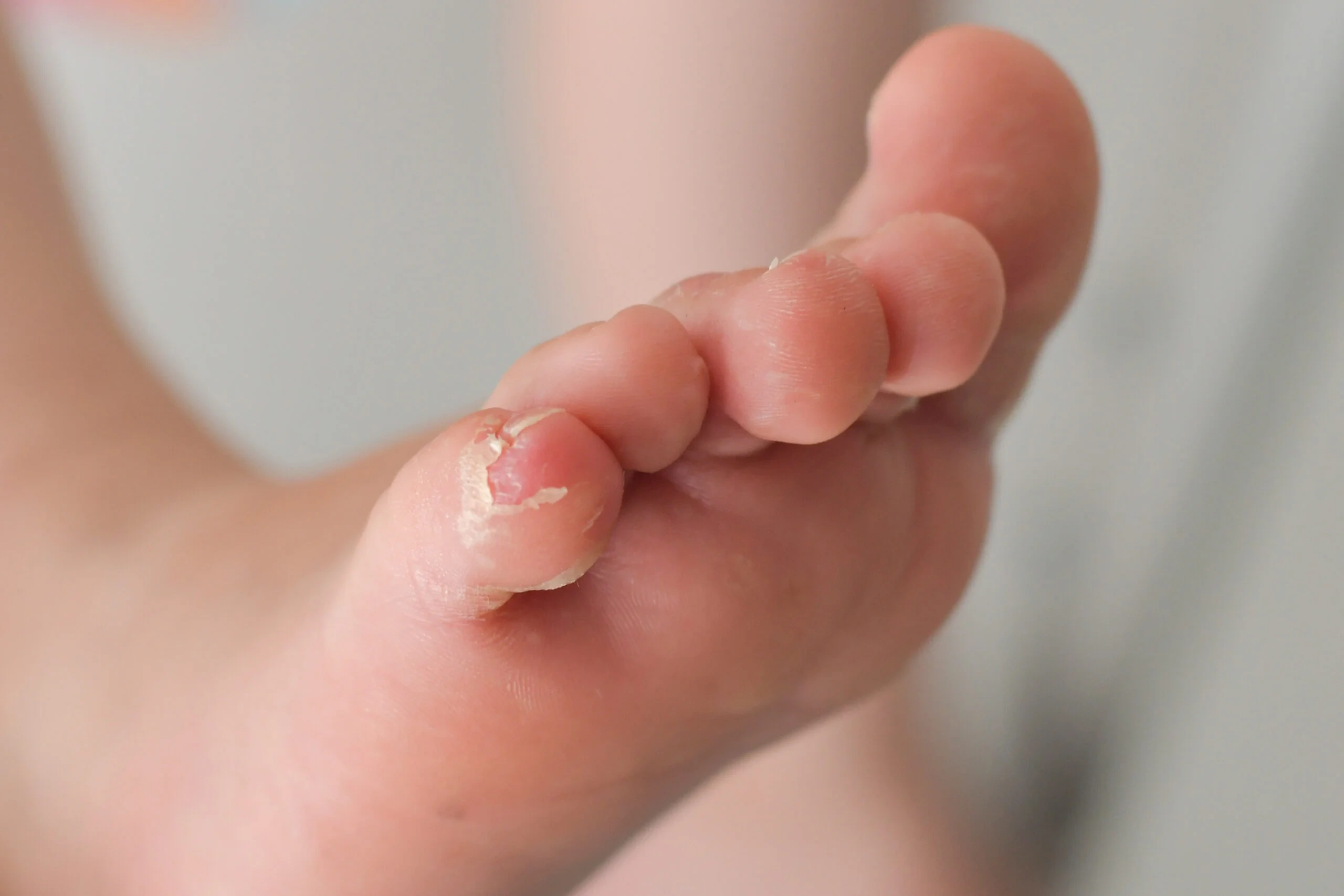 Blister on Bottom of Pinky Toe: Why It Happens (and How To Make It Stop)