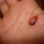 Blood Blisters on Skin: Causes & Treatment