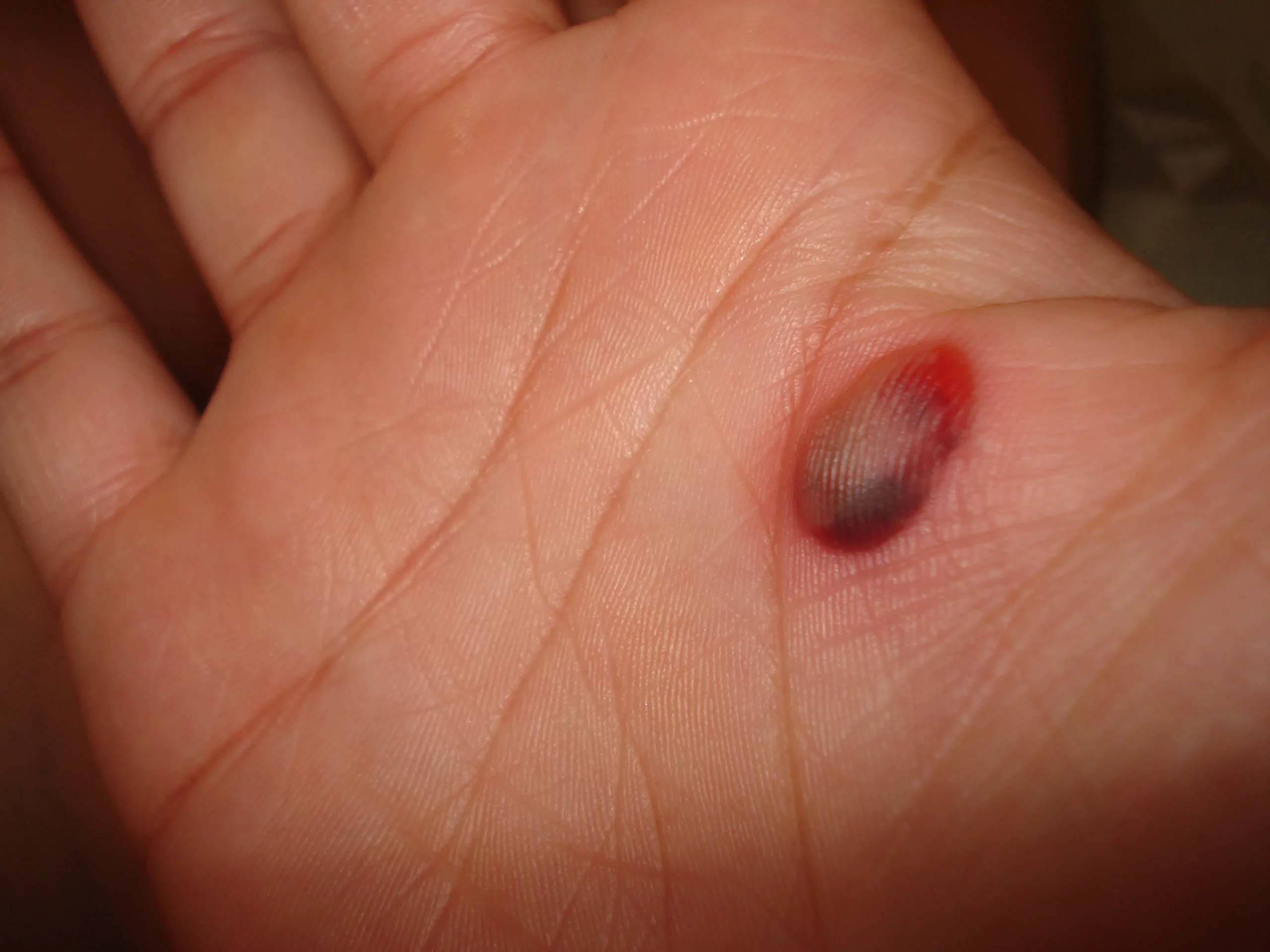 Blood Blisters on Skin: Sneaky Spots, Surprising Stories