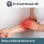 Arm Pain? Signs of Blood Clot in Arm