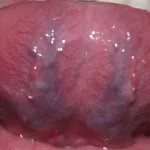 Blood Vessels Under the Tongue NHS: What Yours Might Be Telling You
