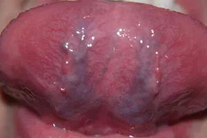 Blood Vessels Under the Tongue NHS: What Yours Might Be Telling You