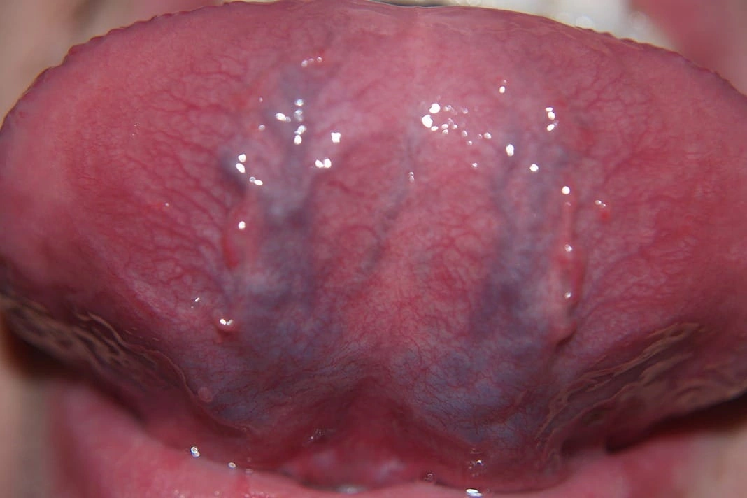 Blood Vessels Under the Tongue NHS: What Yours Might Be Telling You
