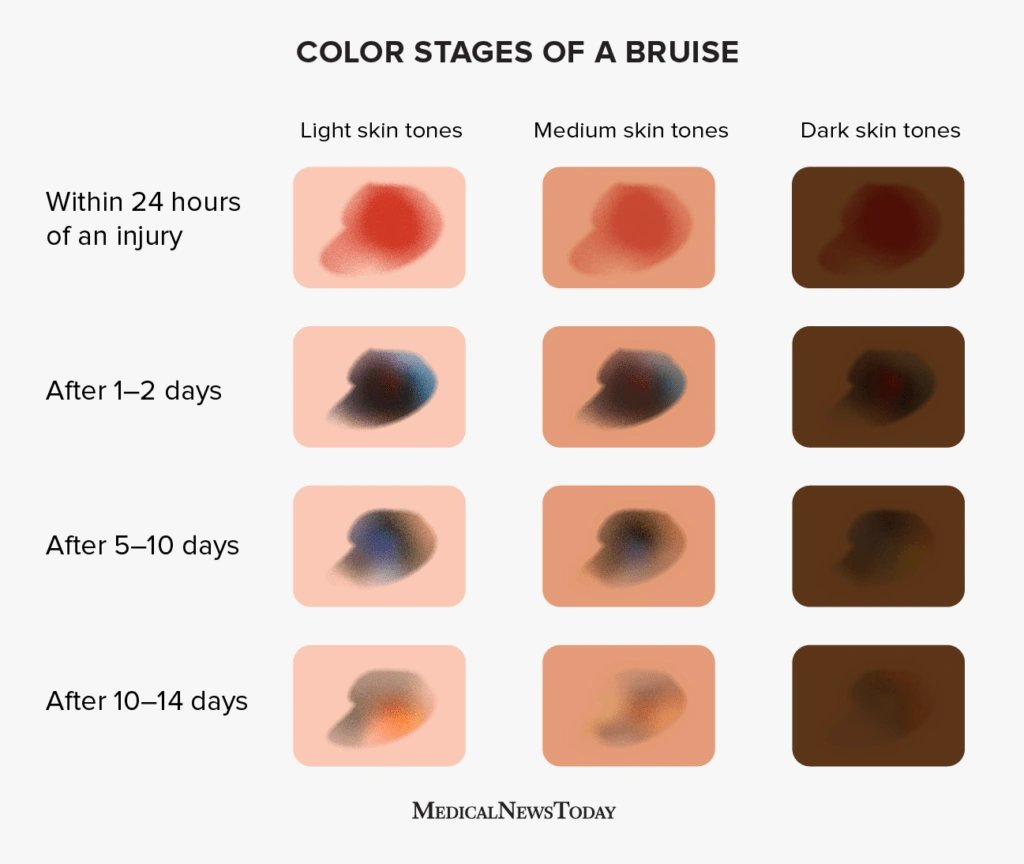 Bruise Identifying Chart for Seniors: Colors, Clues & Everyday Wisdom