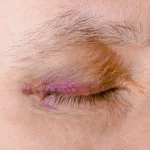 Causes of Bruising on Eyelid for No Reason