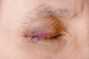 Bruising on Eyelid for No Reason: What’s Up With That?