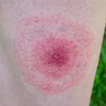Bug Bite with Bruise Around It Pictures Guide