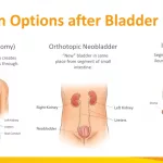 Can Bladder Cancer Return After Removal?
