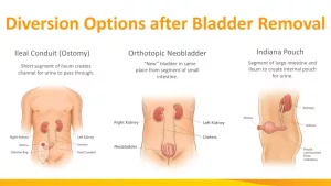 Can Bladder Cancer Return After Bladder Removal? Here’s the Honest, Human Truth