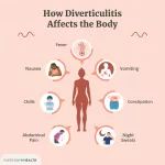 Can Diverticulitis Cause Night Sweatts?