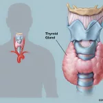 Can Graves' Disease Kill You? Key Risks