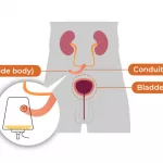 Can You Live Without a Bladder? Key Facts