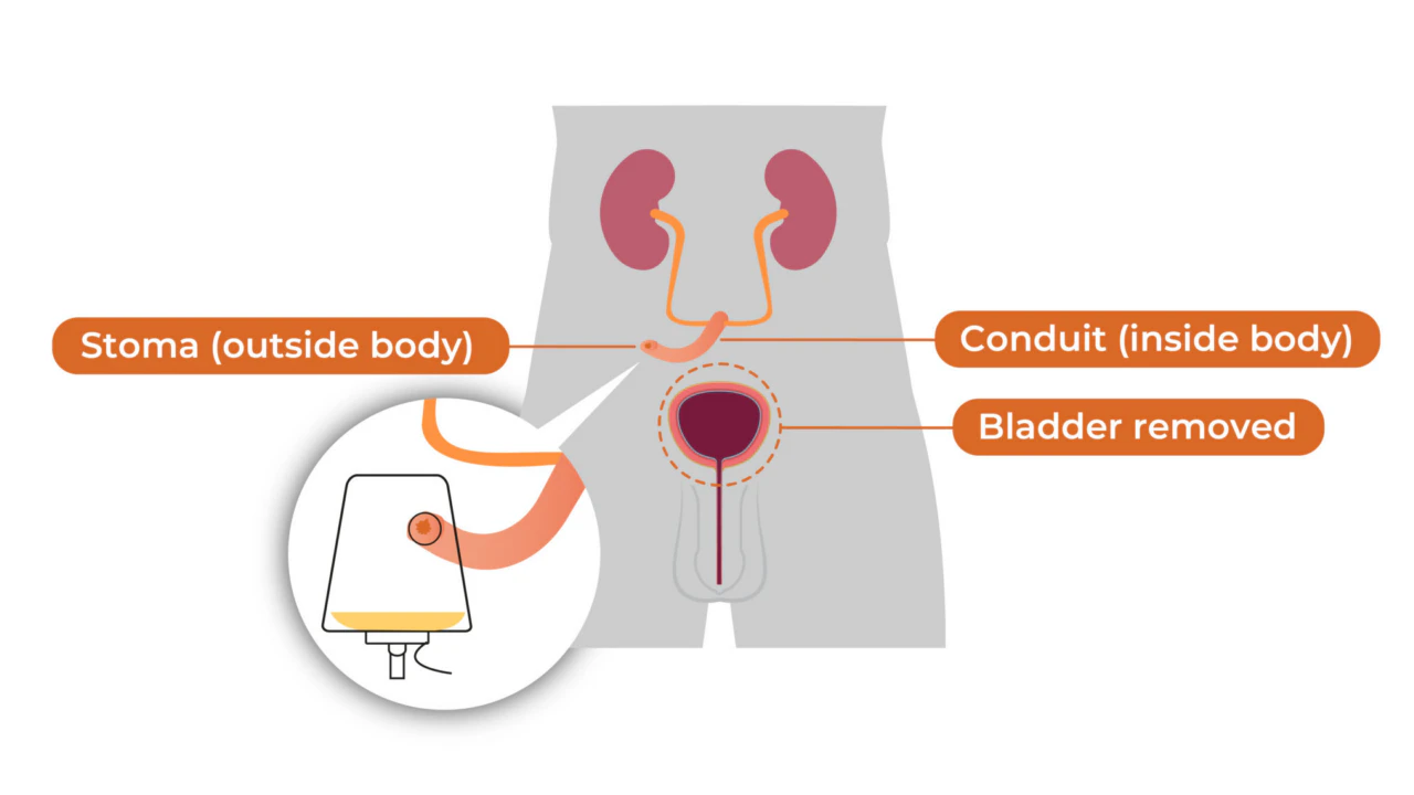 Can You Live Without a Bladder? Real Talk on Thriving After Surgery