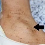 Cancer Pictures of Swollen Lymph Nodes in Armpit