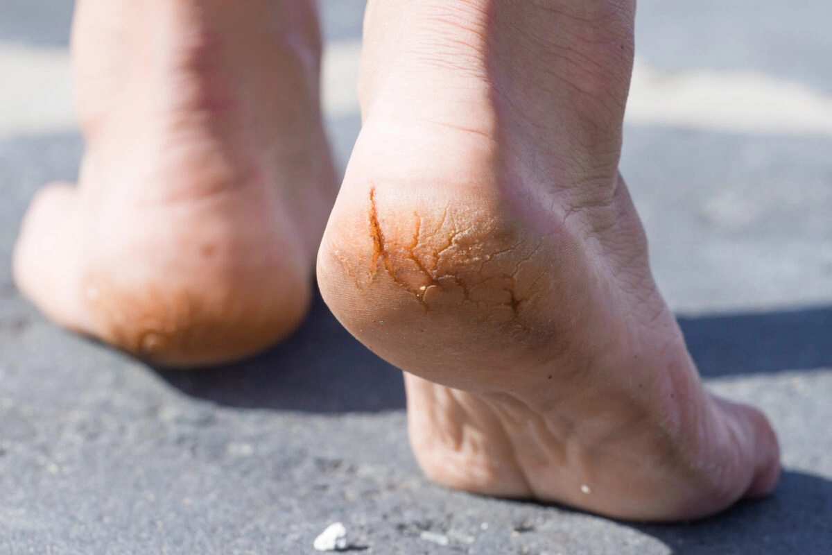 Castrol Oil for Legs and Feet Cracks: Your Underrated Moisture Hero