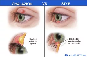 Chalazion Healing Stages Pictures: What to Expect, Day by Day