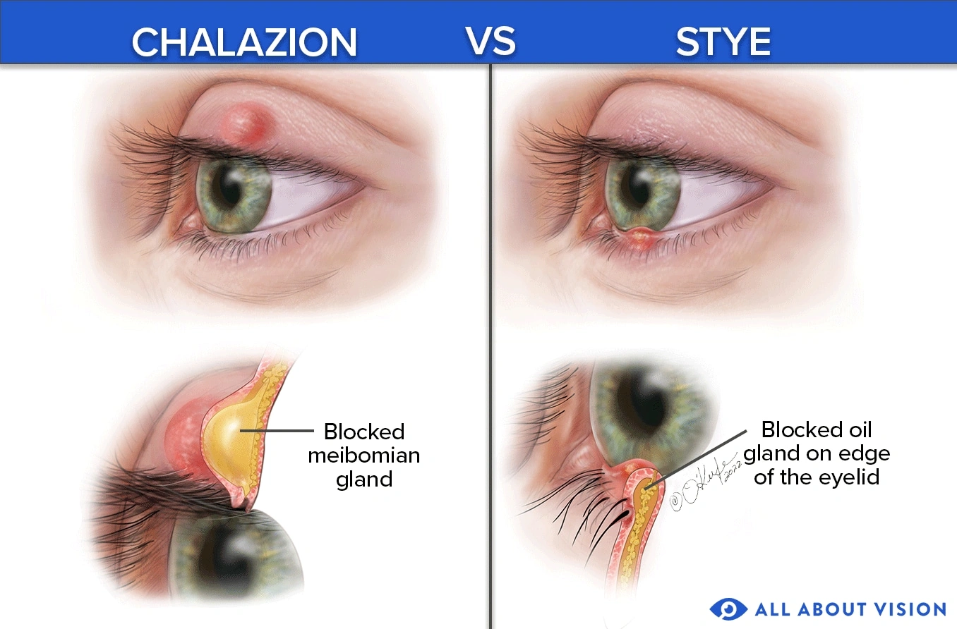 Chalazion Healing Stages Pictures: What to Expect, Day by Day