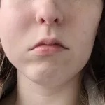 Why Cheek Swelling After Dental Injection Happens