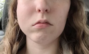 Cheek Swelling After Dental Injection: Why Does This Happen?