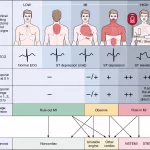 Essential Chest Pain Location Chart