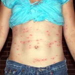 Chiggers Bites Pictures: Spot the Red Itch