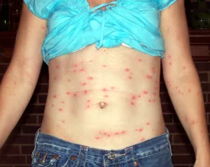 Chiggers Bites Pictures: What They Really Look Like (And Why You’ll Want to Avoid Them) Chiggers Bites Pictures: What They Really Look Like (And Why You’ll Want to Avoid Them)