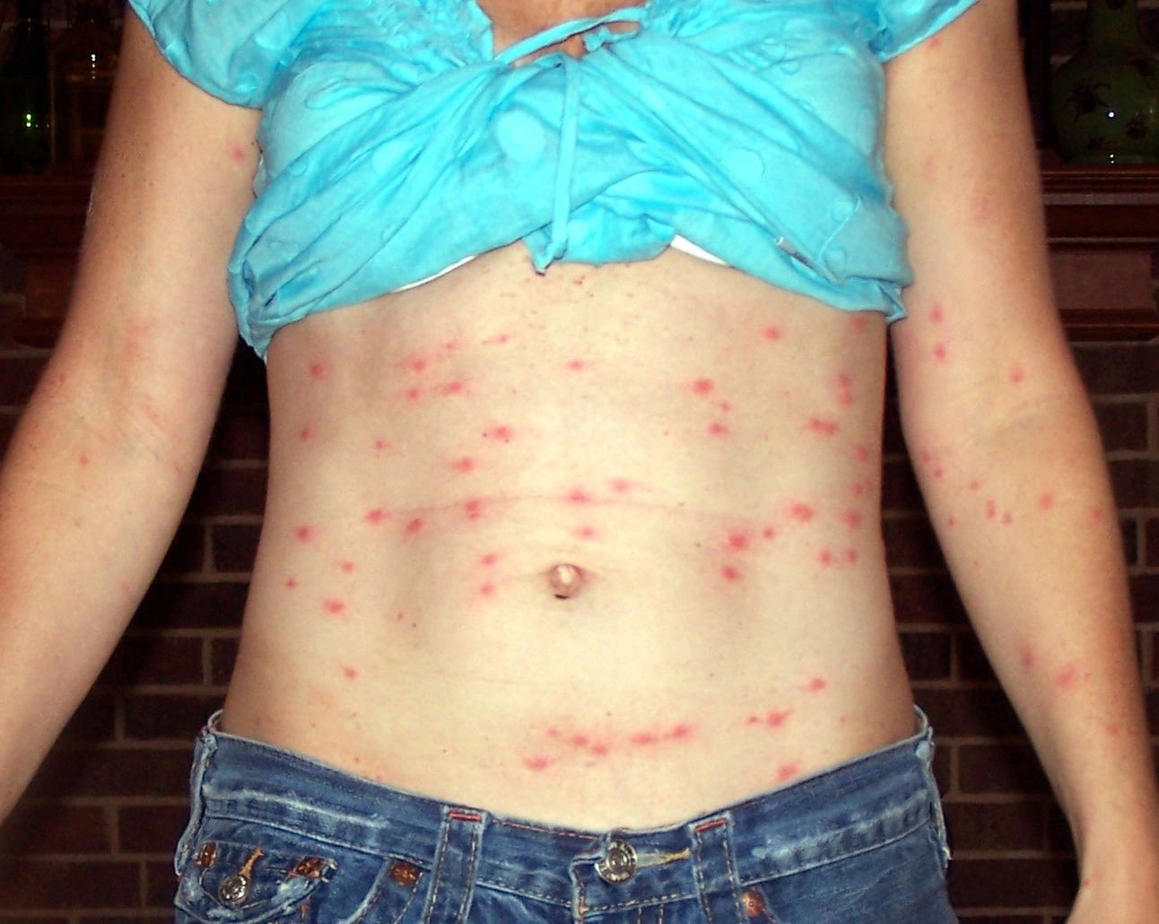 Chiggers Bites Pictures: What They Really Look Like (And Why You’ll Want to Avoid Them)