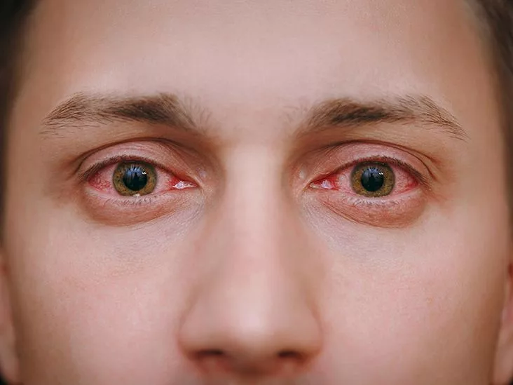 Understanding the Types of Conjunctivitis: Clear Guide
