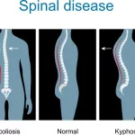 Curve of Weary Spine: Hidden Posture Risks