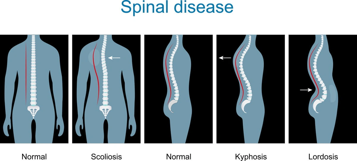 The Curve of a Weary Spine: Why That Subtle Bend Matters