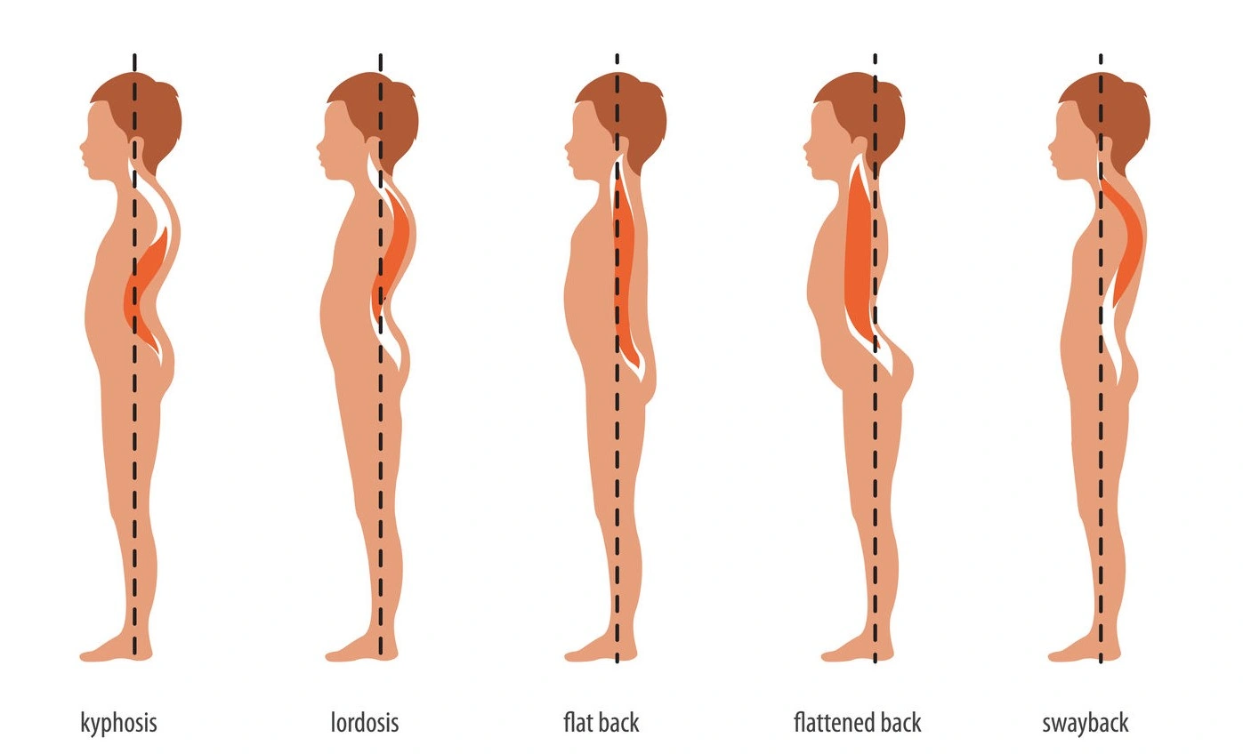 Living with a Curved Spine (Lower Back): What No One Tells You