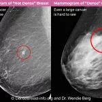 Dense Breast ICD-10 Demystified: What You Need To Know Dense Breast ICD-10 Demystified: What You Need To Know