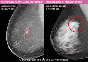 Dense Breast ICD-10 Demystified: What You Need To Know