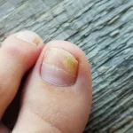 Do Removed Toenails Grow Back? Yes, Mostly