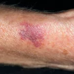 Elderly Skin Bruising Pictures Guide