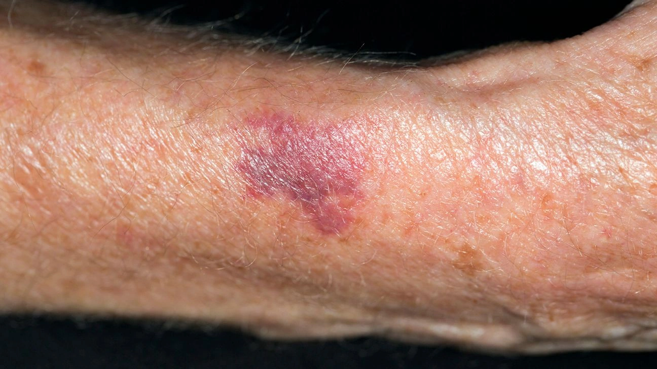 Elderly Skin Bruising Pictures: Understanding and Easing Worry