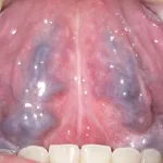 Enlarged Veins Under Tongue: Noticing, Worrying, Laughing a Little (& Learning a Lot) Enlarged Veins Under Tongue: Noticing, Worrying, Laughing a Little (& Learning a Lot)