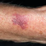 Causes of Excessive Bruising in Seniors