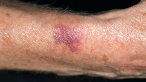 Excessive Bruising in Seniors: What’s Really Going On? Excessive Bruising in Seniors: What’s Really Going On?