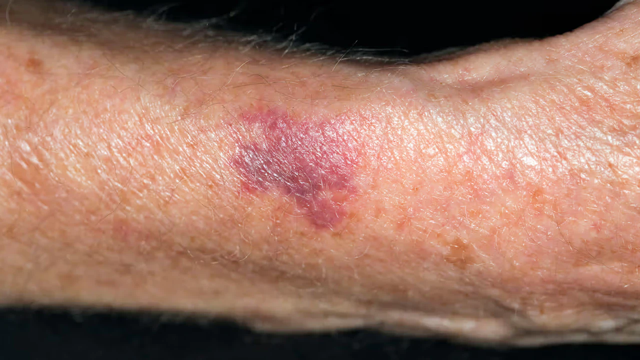 Excessive Bruising in Seniors: What’s Really Going On?
