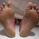 Foot Fungus Pictures: Spot Symptoms Early